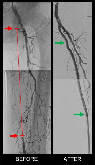 Femoral Artery Blockage