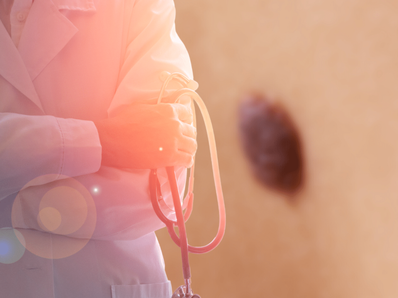 Mohs Surgery St. Luke Skin Cancer Treatment